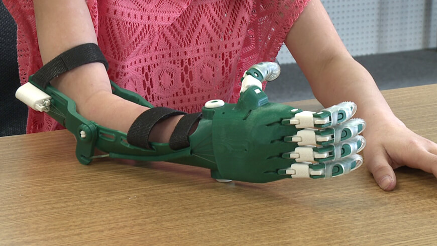 3D Printed Prosthetics