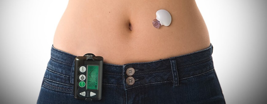 What Is Living With An Artificial Pancreas Like?