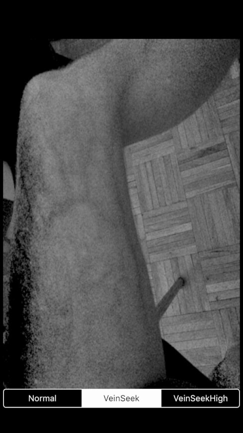 vein scanner