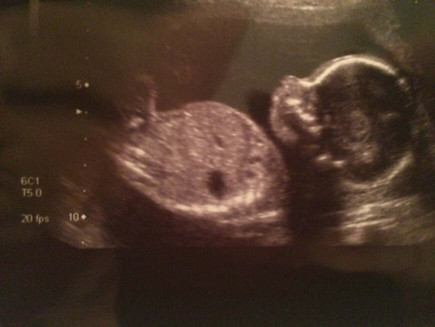 Boy or girl - designer baby